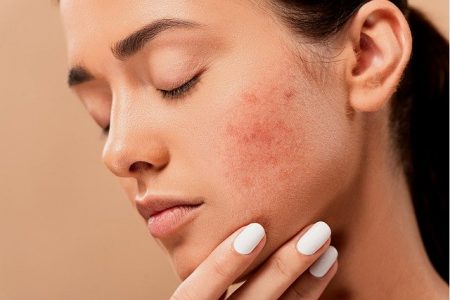 #peau #allergie #acné